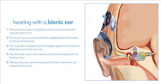 How a Cochlear Implant Works
